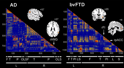 William Seeley, MD, used MRI and other data collected from healthy people and patients, maps of neural connectivity and analysis tools to answer questions about different neurodegenerative diseases, including the two most common forms of dementia, Alzheimer's disease (AD) and frontal temporal dementia (FTD). Seeley found these diseases may be most likely to spread within the brain by moving directly between connected neurons.