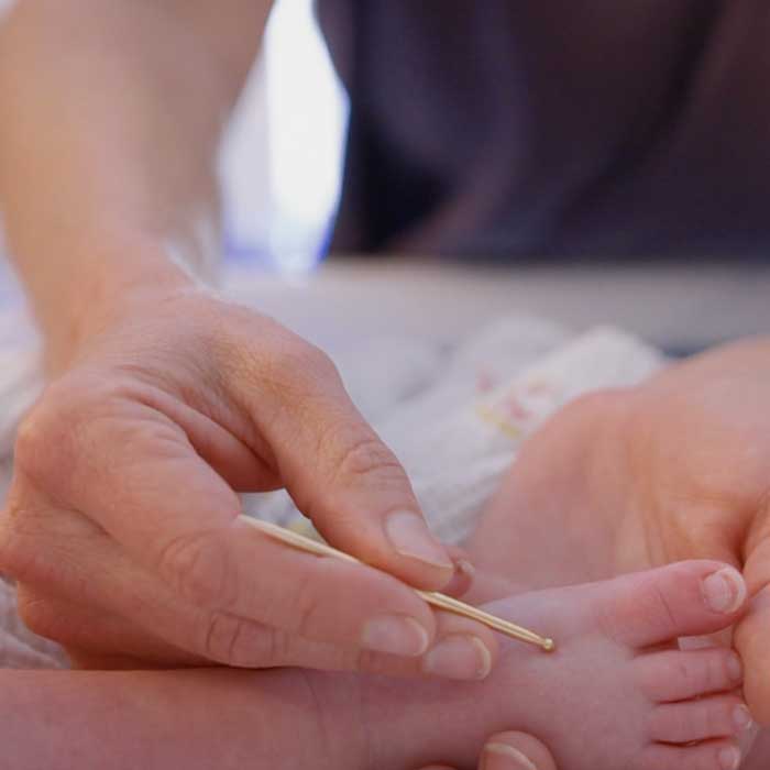 A physician runs over a baby's foot with a point massage tool.